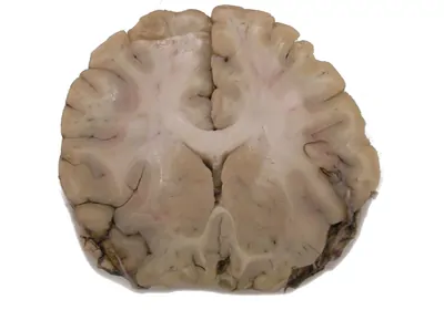 Coronal section of a brain
